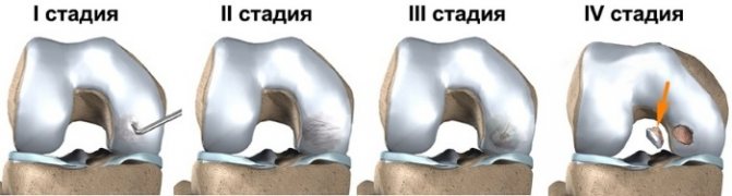 Болезнь Кенига коленного сустава. Что это такое, лечение, стадии у детей, спортсменов, взрослых, операция