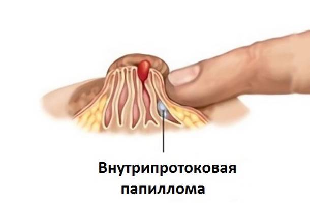 Что такое внутрипротоковая папиллома молочной железы