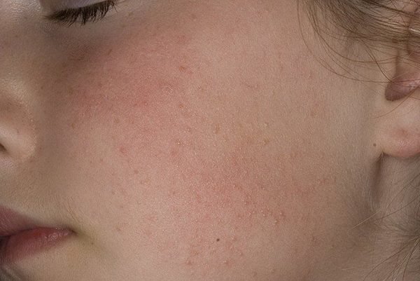 Дискератоз – симптомы и лечение, фото и видео.