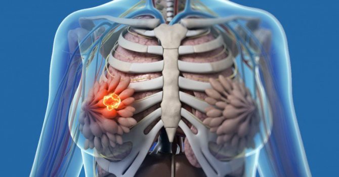 Дисплазия молочной железы что это такое