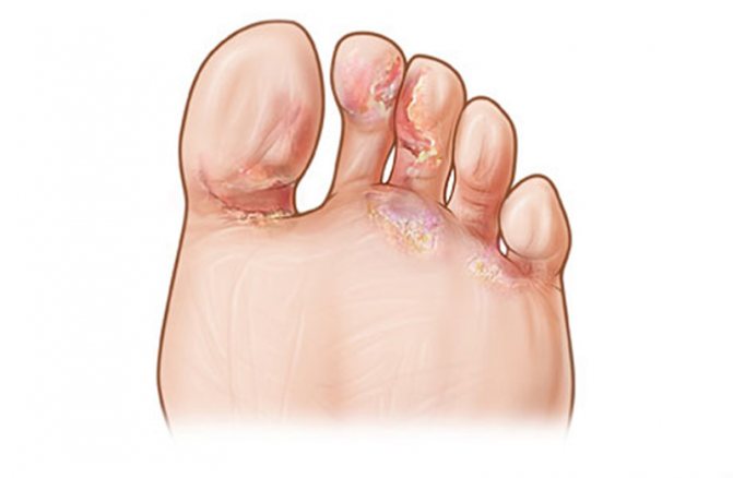 Эпидермофития стоп: фото, симптомы и лечение