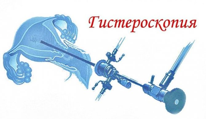 гистероскопия и зачатие
