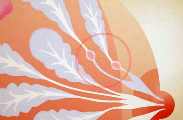 Интрадуктальные папилломы молочной железы