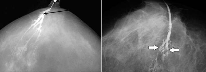 исследование папилломы в протоке