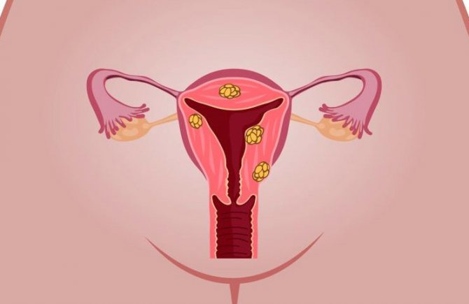 множественные опухоли