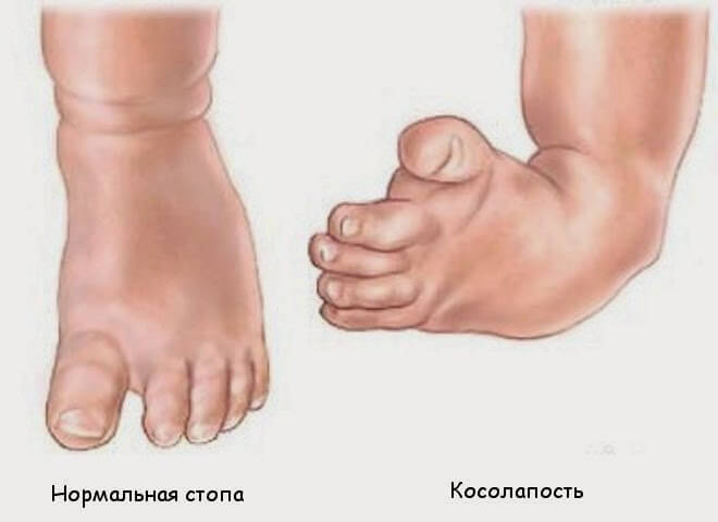 нормальная нога и нога с косолапостью