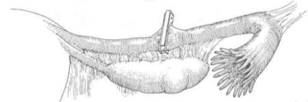 Перевязка маточных труб клипами Фильши фото