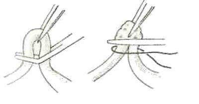 Перевязка маточных труб по Мадленеру фото
