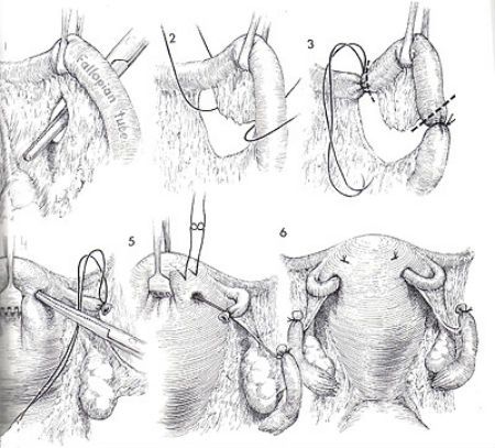 Перевязка маточных труб по методу Ирвинга фото