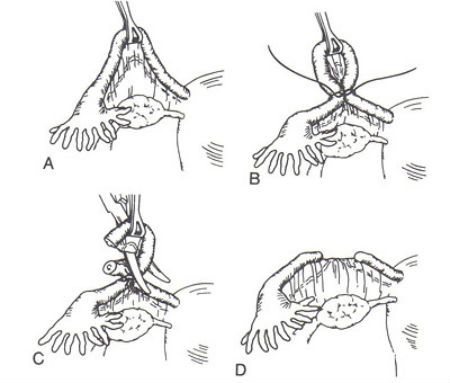Перевязка маточных труб по методу Помероя фото