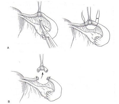 Перевязка маточных труб по Причарду фото