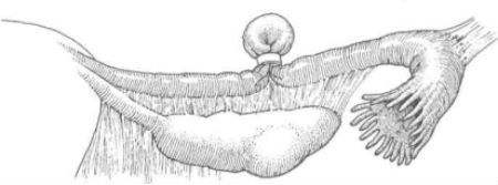 Перевязка маточных труб при помощи кольца фото