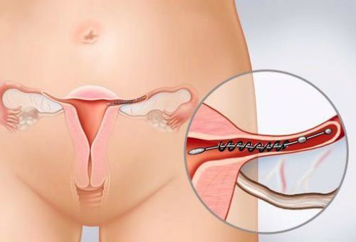Перевязка маточных труб при помощи трубных имплантатов фото