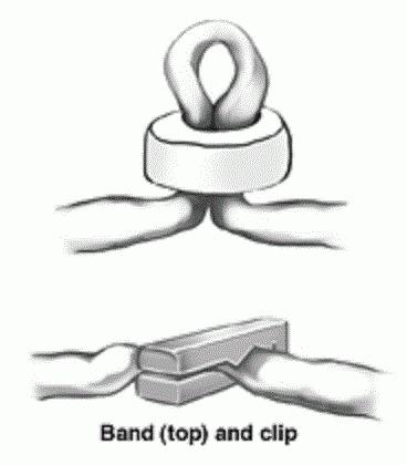 перевязка труб как метод контрацепции не опасен
