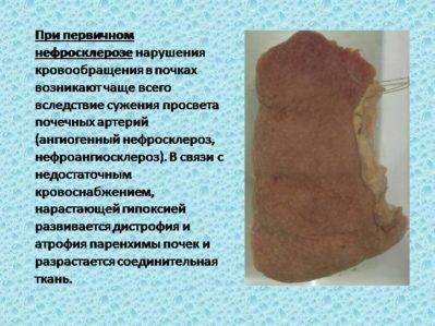 первичный нефросклероз