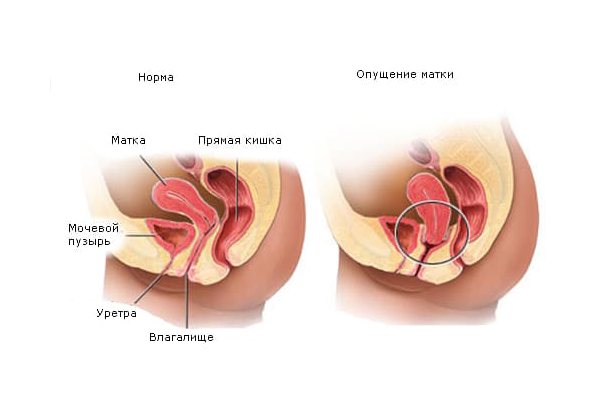 Пессарий при опущении отзывы 1