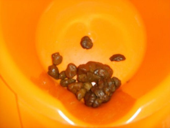 Почему кал горошком у взрослого