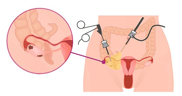 Рассмотрим, для чего нужна лапароскопия при СПКЯ и как проводится данная операция...