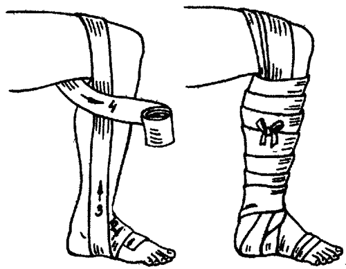 схема бинтование по методике Финнка-Этингена