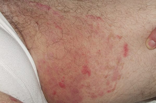 Тактика лечения паховой эпидермофитии у мужчин