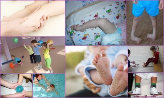 Упражнения при косолапии у ребенка - выполнение