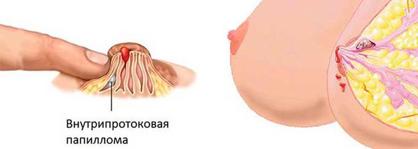 Внутрипротоковая папиллома молочной железы