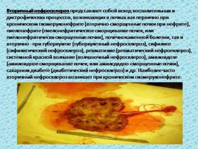 вторичный нефросклероз