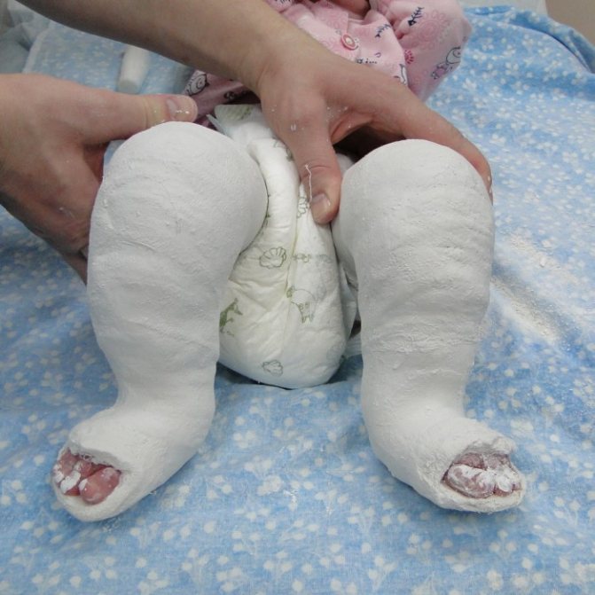 загипсованные ноги маленького ребенка