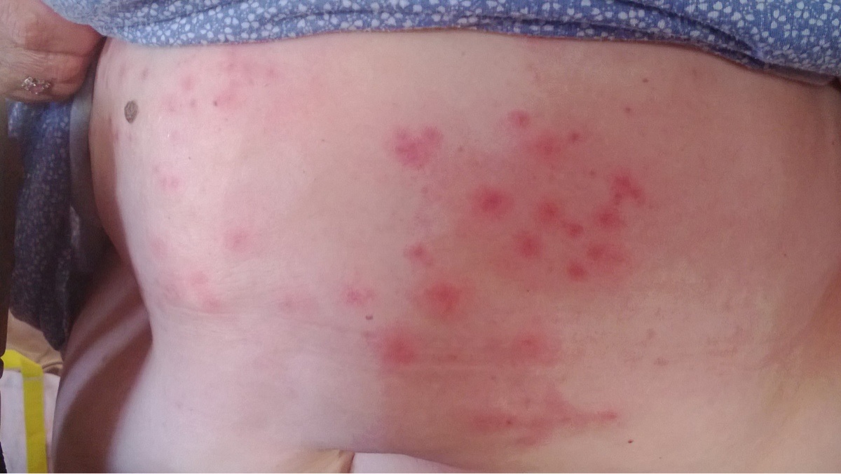 Сыпь на животе во время беременности
