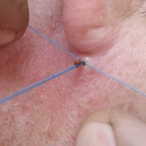 Ребенка укусил клещ что делать