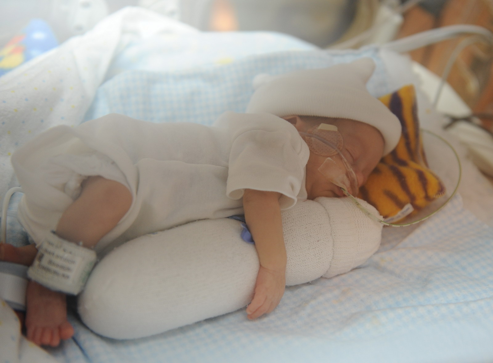 Неразвитый ребенок Гипотрофия плода