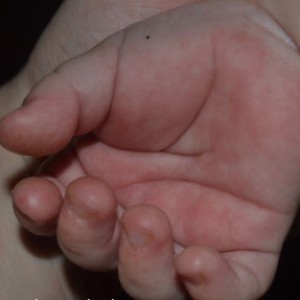 шелушение кожи Причины шелушения кожи на ладошках