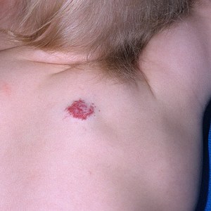 Гемангиома у грудничка