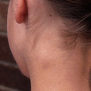 У девочки на шее шишка Шишка на шее слева у ребенка