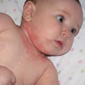 У малыша сыпь на шее Прыщики на лице и шее у грудничка