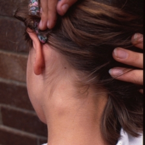 симптомы увеличенного лимфоузла Увеличен шейный лимфоузел