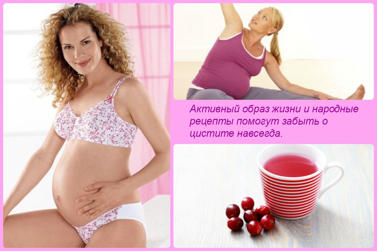 Цистит при беременности