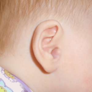 Гемангиома у грудничка