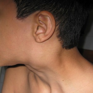 У ребенка на шее видны шишки Шишки на шее сбоку у ребенка