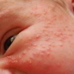 На лице ребенка появились белые прыщики Белые прыщики на лице у грудничка