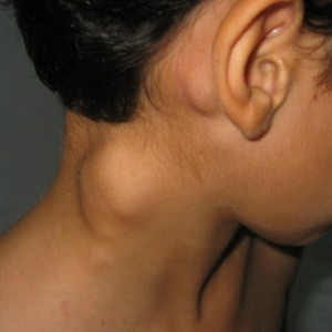 У мальчика две шишки на шее Шишка на шее сбоку справа у ребенка