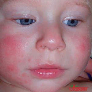 У малыша аллергия Маленькие красные прыщики на лице у грудничка