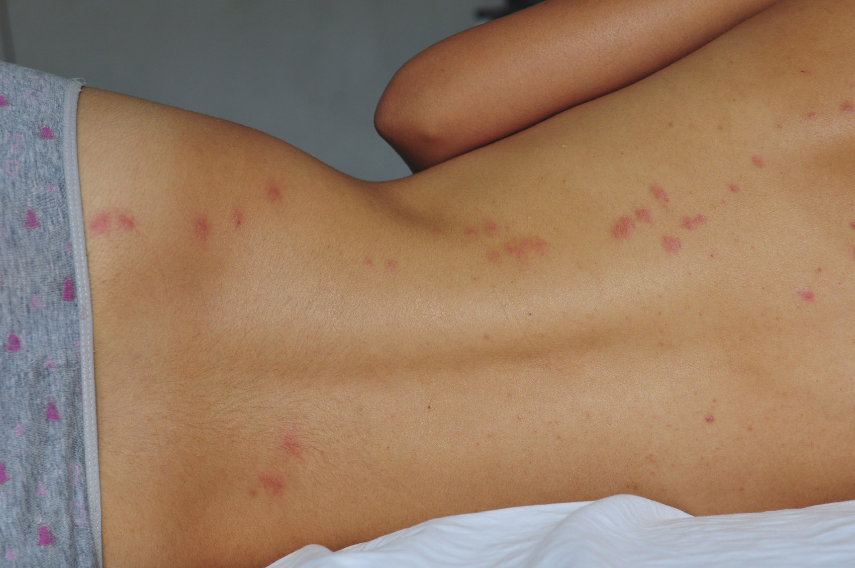 Чешется тело при беременности