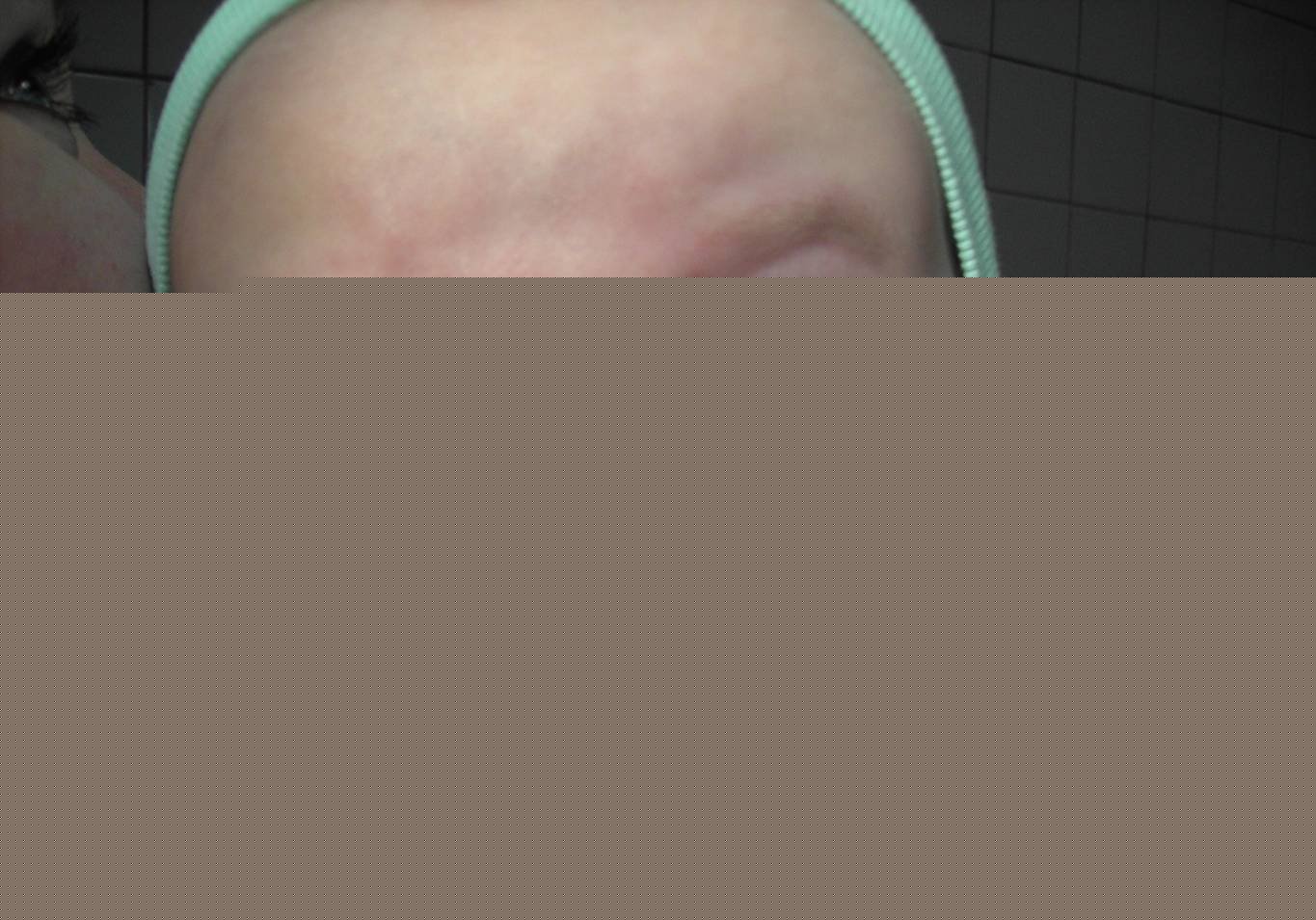 В глазках гной  Дакриоцистит у новорожденных