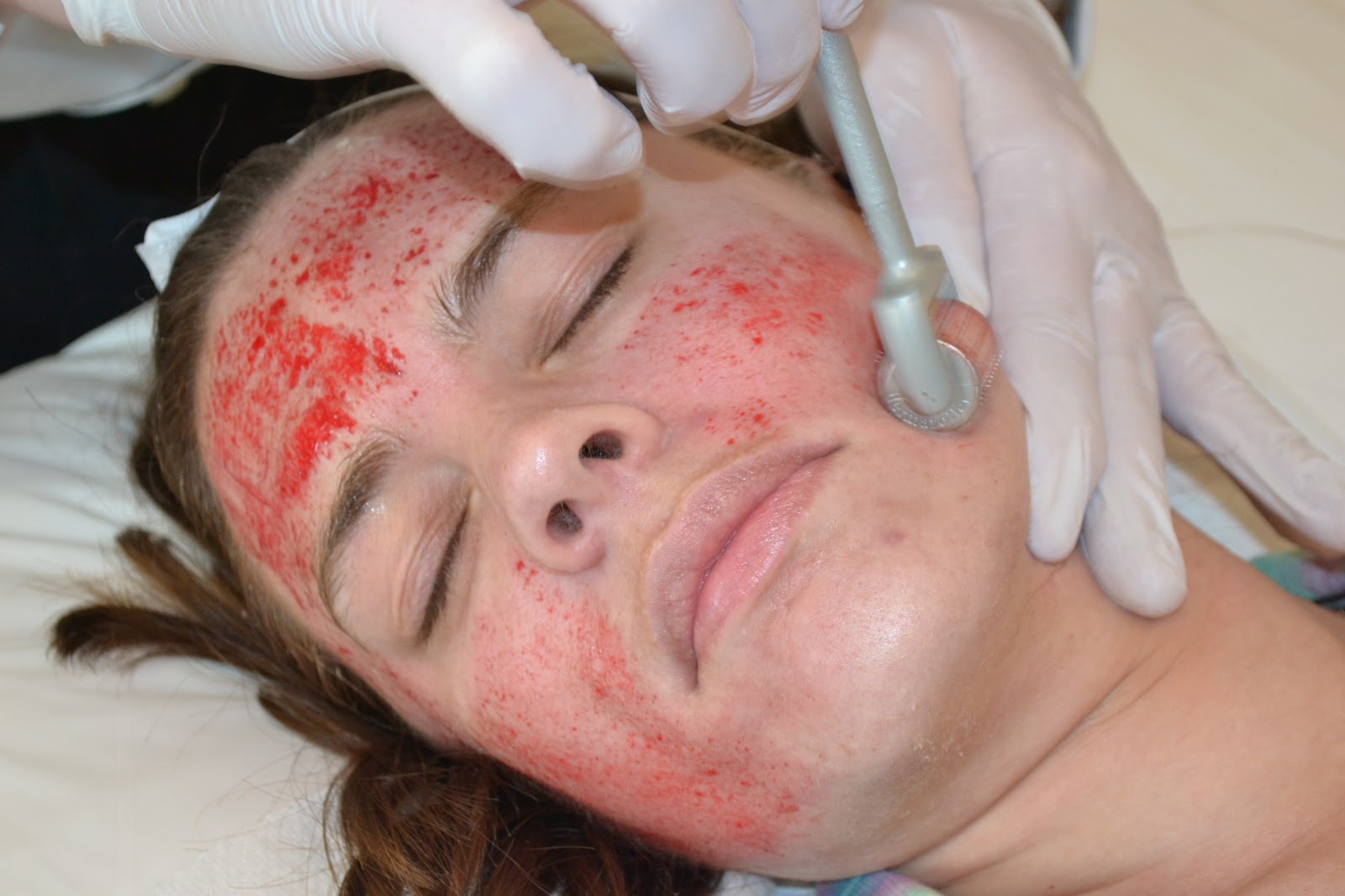 Пигментация при беременности