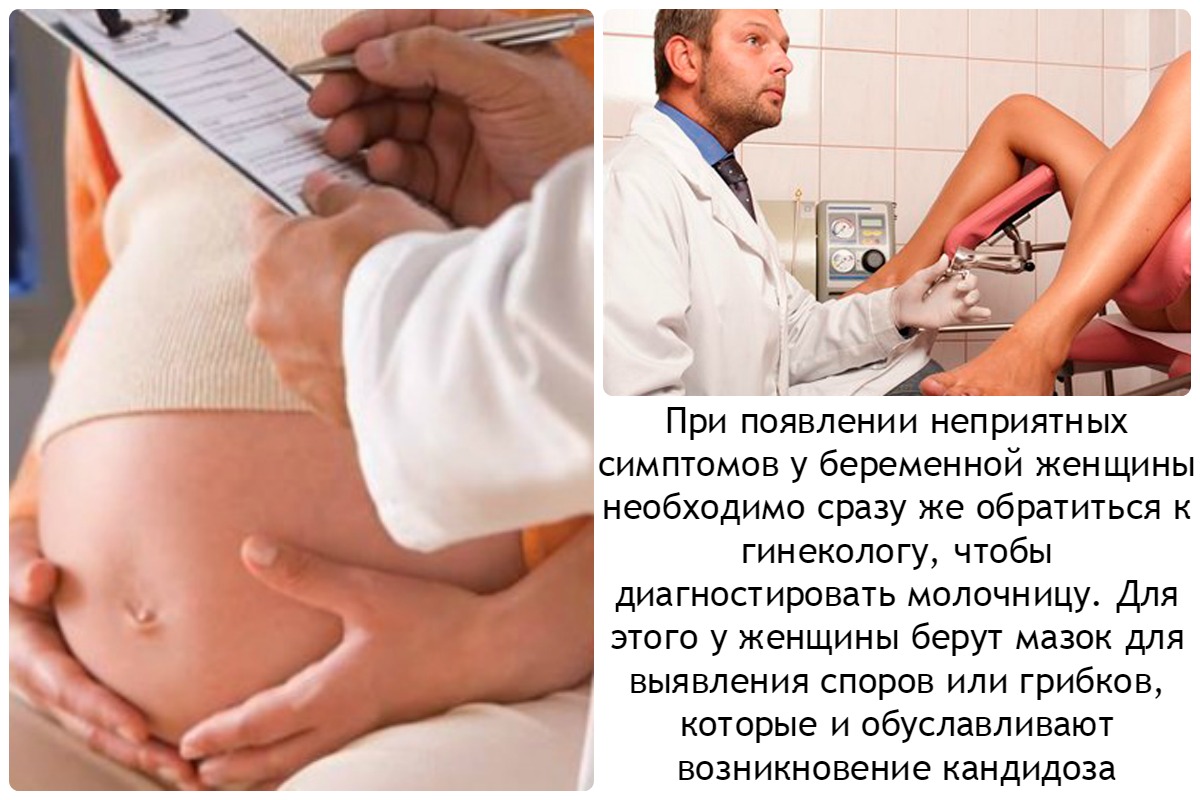 Симптомы Молочница при беременности