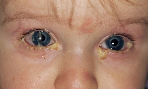 Лечение конъюнктивита