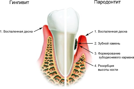 гингивит и пародонтит