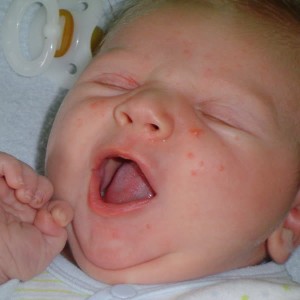 Профилактика аллергии