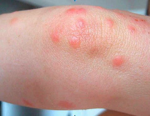 Укусы насекомых у ребенка